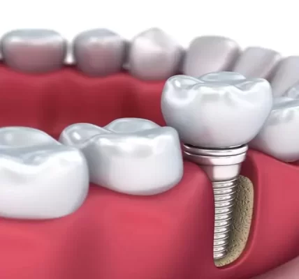 Dental Implants