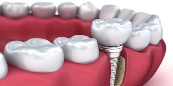 Dental Implants