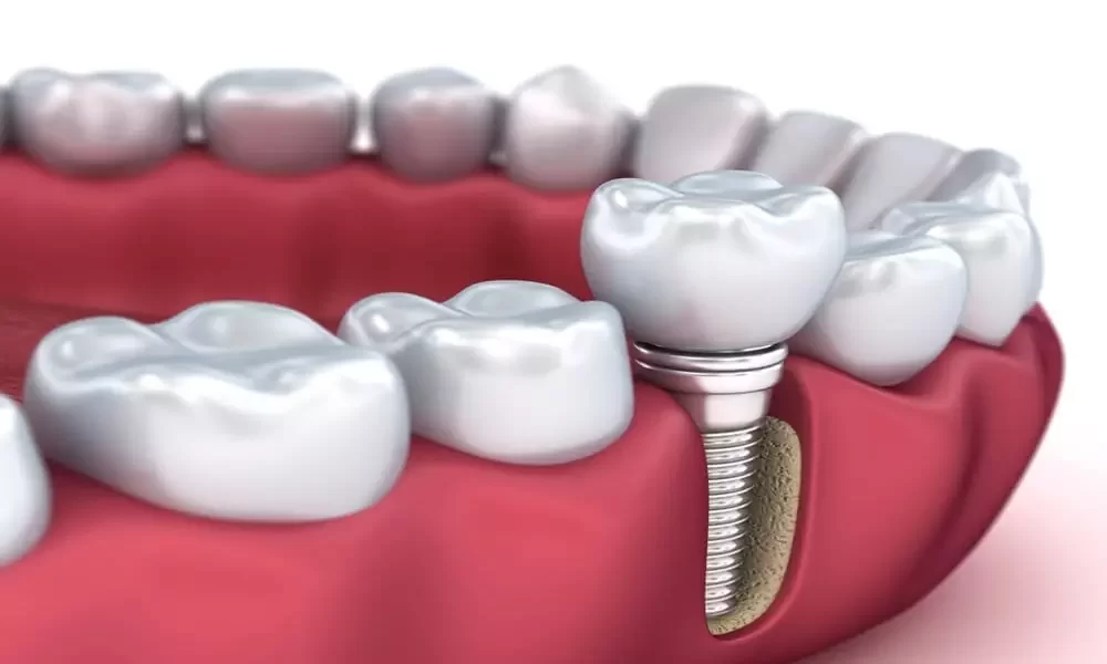 Dental Implants